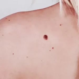 Невус. Удаление невуса в Симферополе